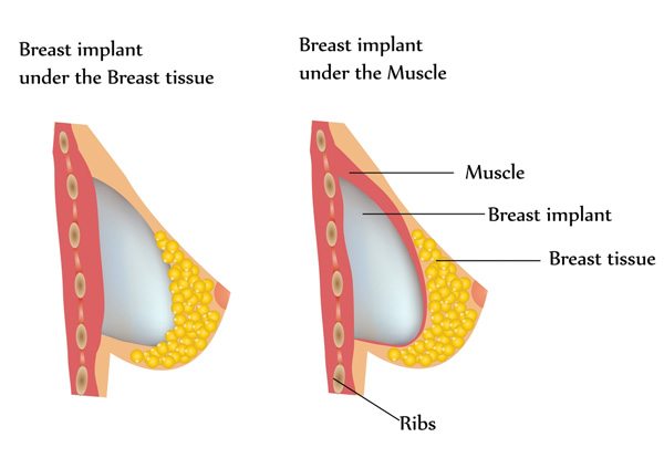 cost of transumbilical breast Cost of transumbilical breast