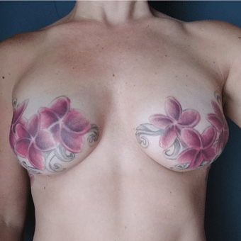 breast surgery board-certified plastic surgeon charlotte nc