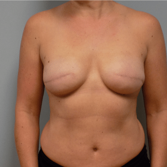breast surgery before and after charlotte NC