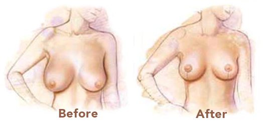 Breast reduction illustration