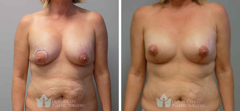 Breast Lift with Breast Aug - Case 3212 - before and after front view
