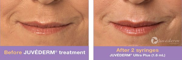 juvederm lip area before and after