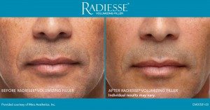 radiesse before and after