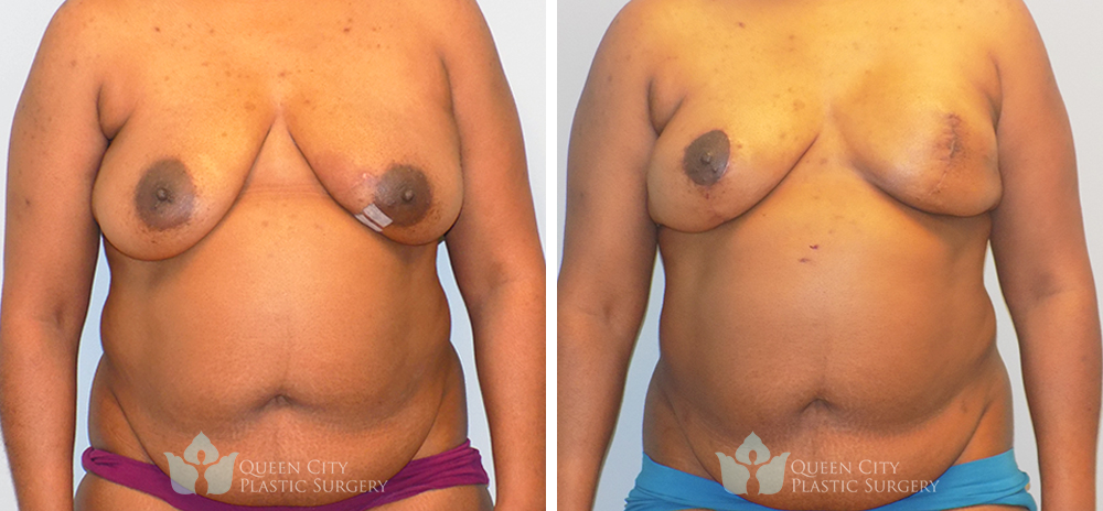 Breast Reconstruction - Before and After