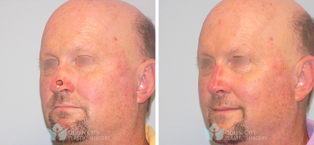 Reconstruction After Mohs Surgery - Before and After