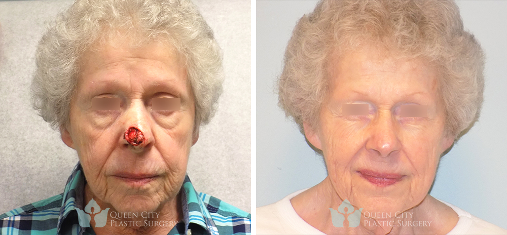 Reconstruction After Mohs Surgery - Before and After
