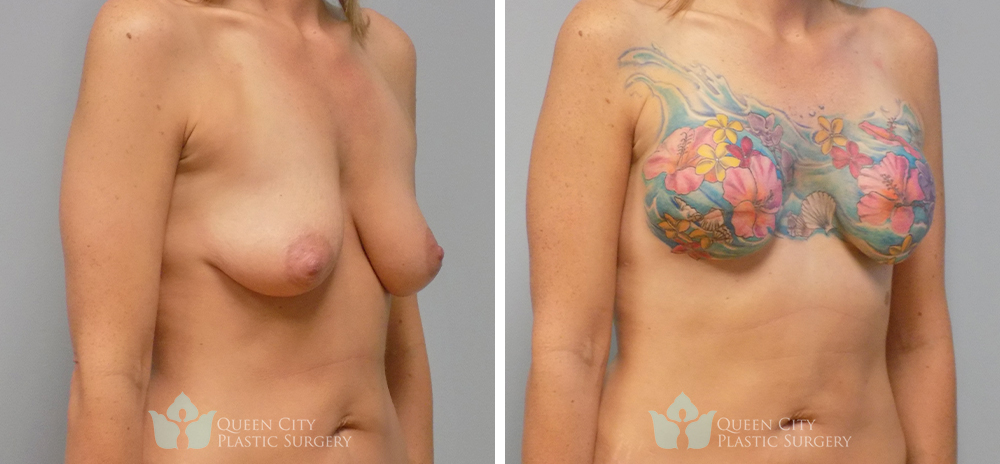 Implants with mastectomy tattoo - Before and After