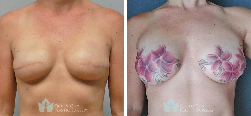 Implants with mastectomy tattoo - Before and After