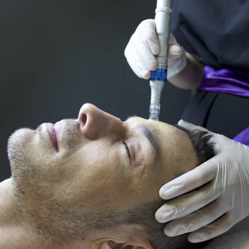 man getting a microneedling treatment