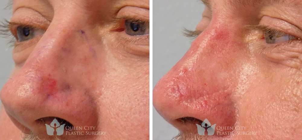 Skin Cancer Before & After