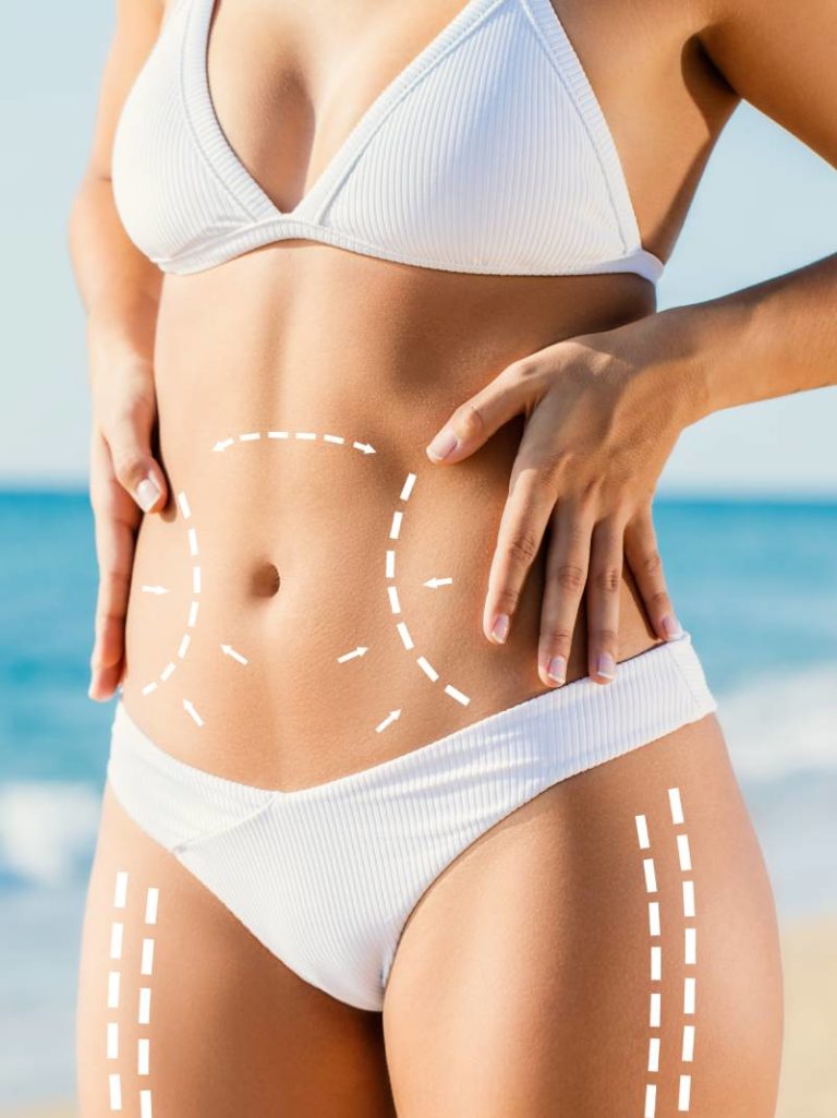 Woman in white bikini with surgery markings