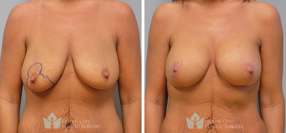 Breast Lift with Augmentation Before & After