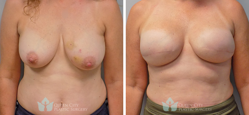 Breast Reconstruction Before & After