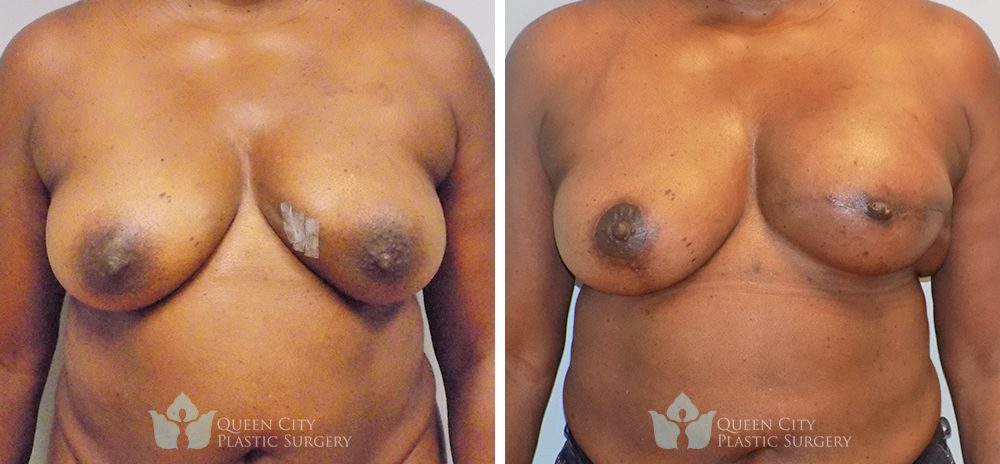 Breast Reconstruction Before & After