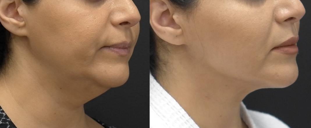 Nonsurgical Jawline Contouring Charlotte, NC