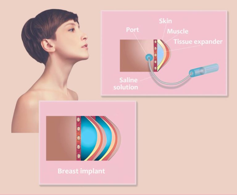 breast expanders, qc plastic surgery