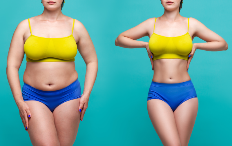 Queen City Plastic Surgery, Body Contouring, Weight Loss