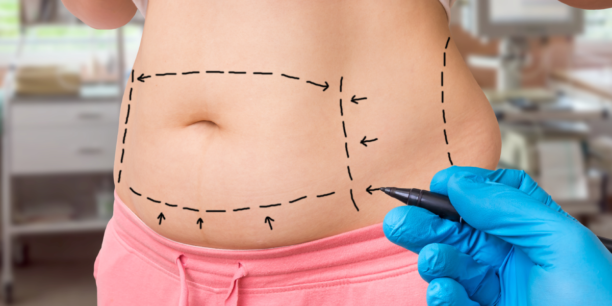 Tummy Tuck