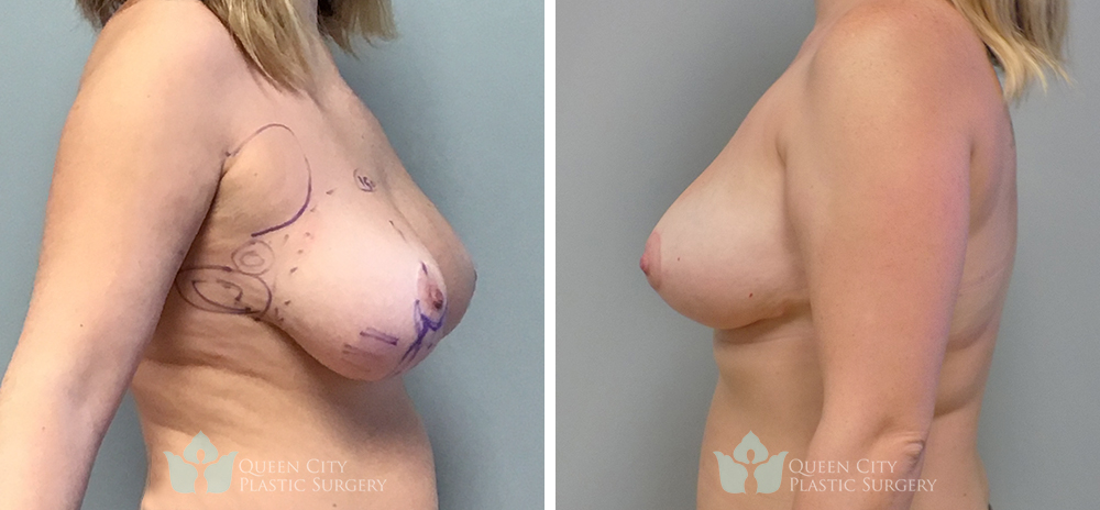 Real Patient of Dr. Enam Haque of Queen City Plastic Surgery in Charlotte, NC