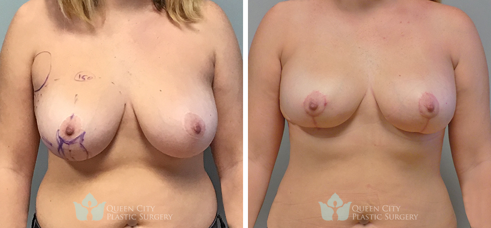 Real Patient of Dr. Enam Haque of Queen City Plastic Surgery in Charlotte, NC