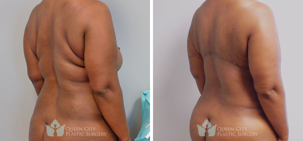 Real Patient of Dr. Enam Haque of Queen City Plastic Surgery in Charlotte, NC