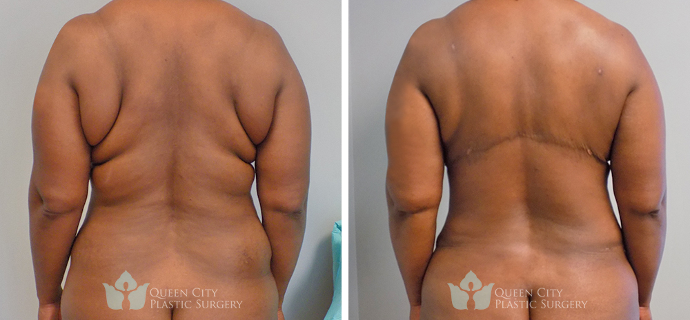 Real Patient of Dr. Enam Haque of Queen City Plastic Surgery in Charlotte, NC