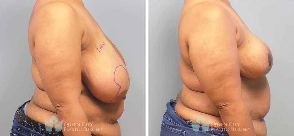 Real Patient of Dr. Enam Haque of Queen City Plastic Surgery in Charlotte, NC