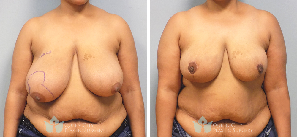 Real Patient of Dr. Enam Haque of Queen City Plastic Surgery in Charlotte, NC