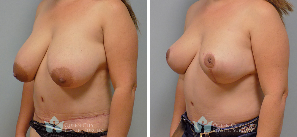 Real Patient of Dr. Enam Haque of Queen City Plastic Surgery in Charlotte, NC