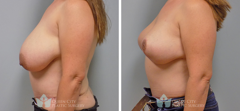 Real Patient of Dr. Enam Haque of Queen City Plastic Surgery in Charlotte, NC