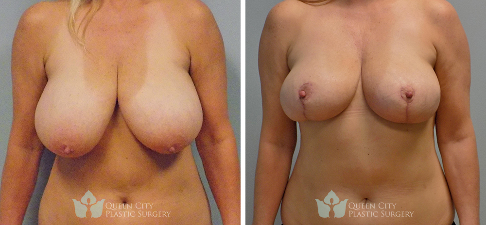 Real Patient of Dr. Enam Haque of Queen City Plastic Surgery in Charlotte, NC