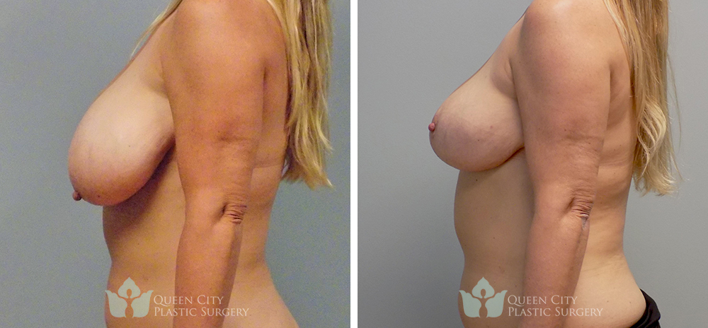 Real Patient of Dr. Enam Haque of Queen City Plastic Surgery in Charlotte, NC