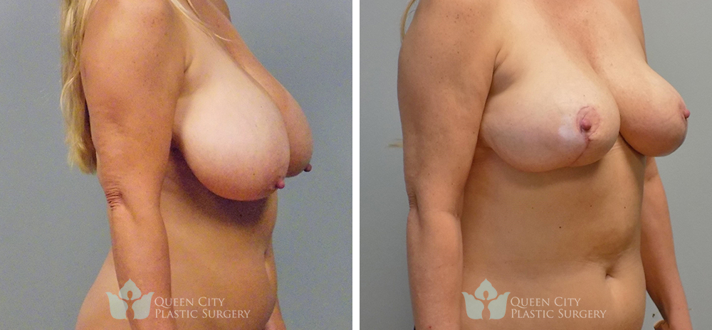 Real Patient of Dr. Enam Haque of Queen City Plastic Surgery in Charlotte, NC