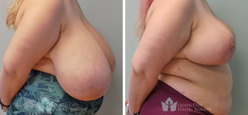 Real Patient of Dr. Enam Haque of Queen City Plastic Surgery in Charlotte, NC