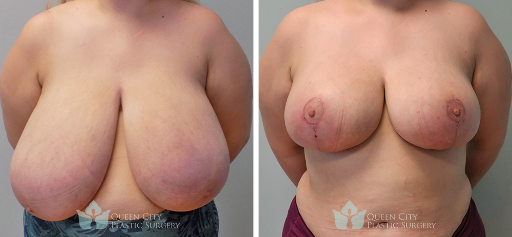 Real Patient of Dr. Enam Haque of Queen City Plastic Surgery in Charlotte, NC