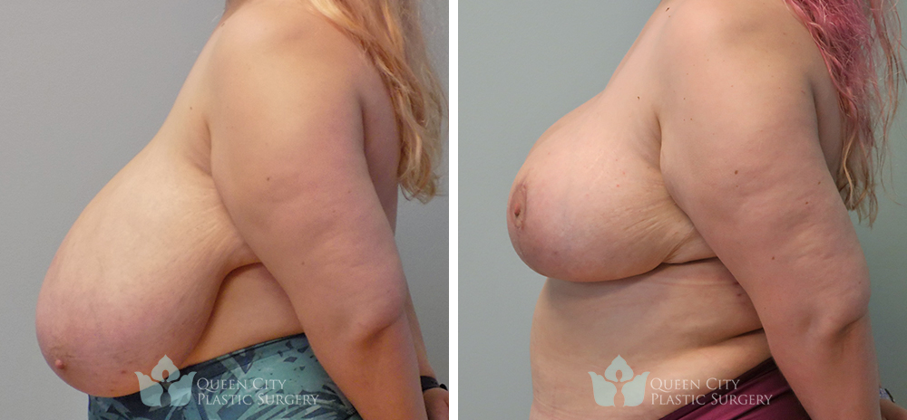 Real Patient of Dr. Enam Haque of Queen City Plastic Surgery in Charlotte, NC