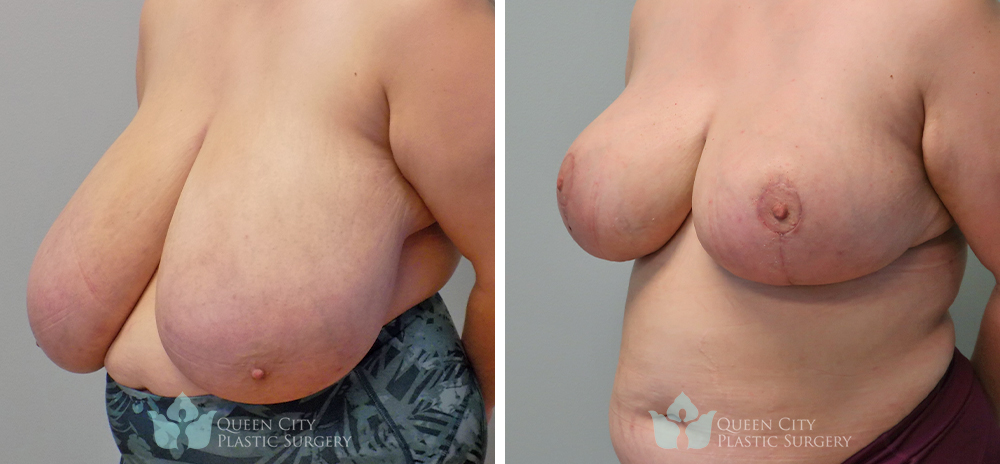 Real Patient of Dr. Enam Haque of Queen City Plastic Surgery in Charlotte, NC