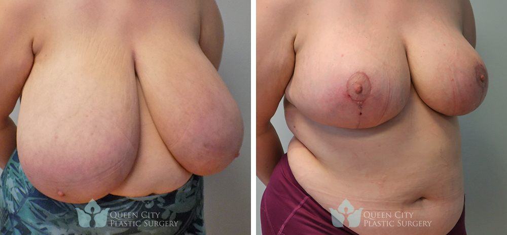 Real Patient of Dr. Enam Haque of Queen City Plastic Surgery in Charlotte, NC