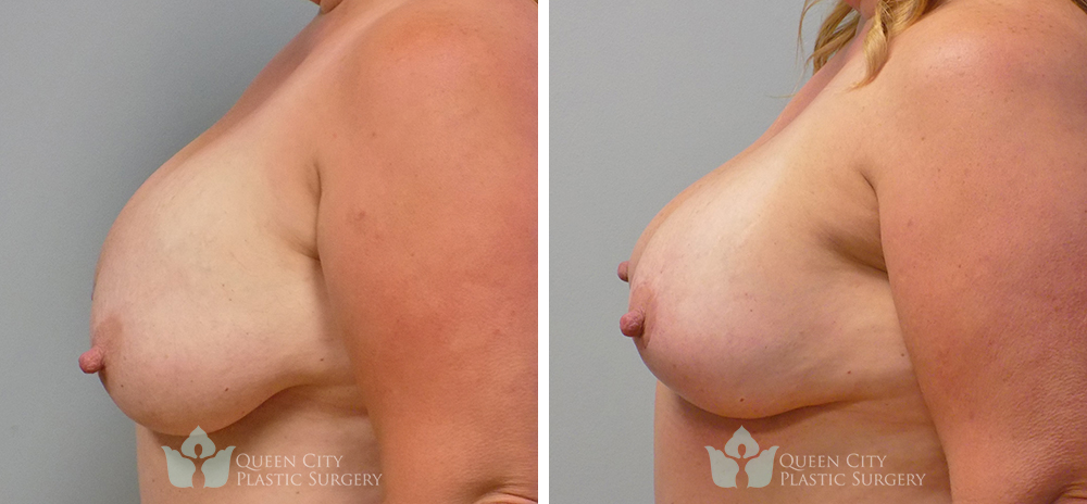 Real Patient of Dr. Enam Haque of Queen City Plastic Surgery in Charlotte, NC