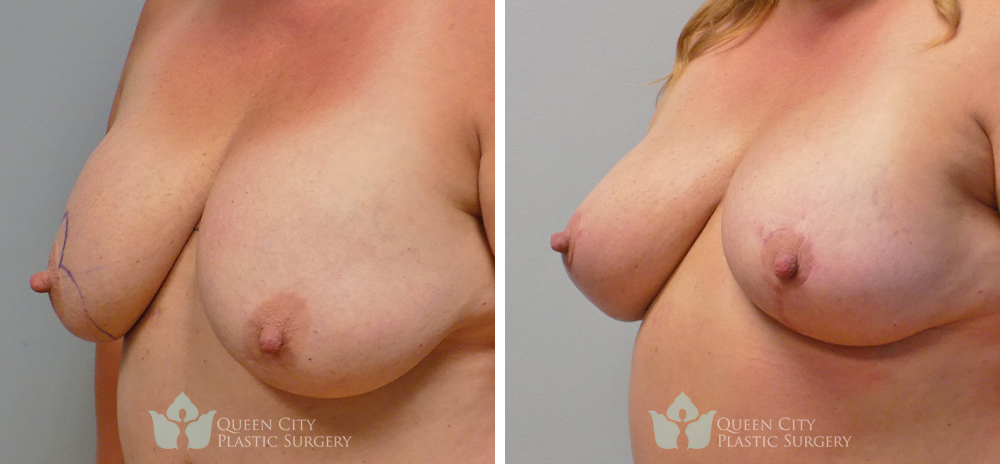 Real Patient of Dr. Enam Haque of Queen City Plastic Surgery in Charlotte, NC