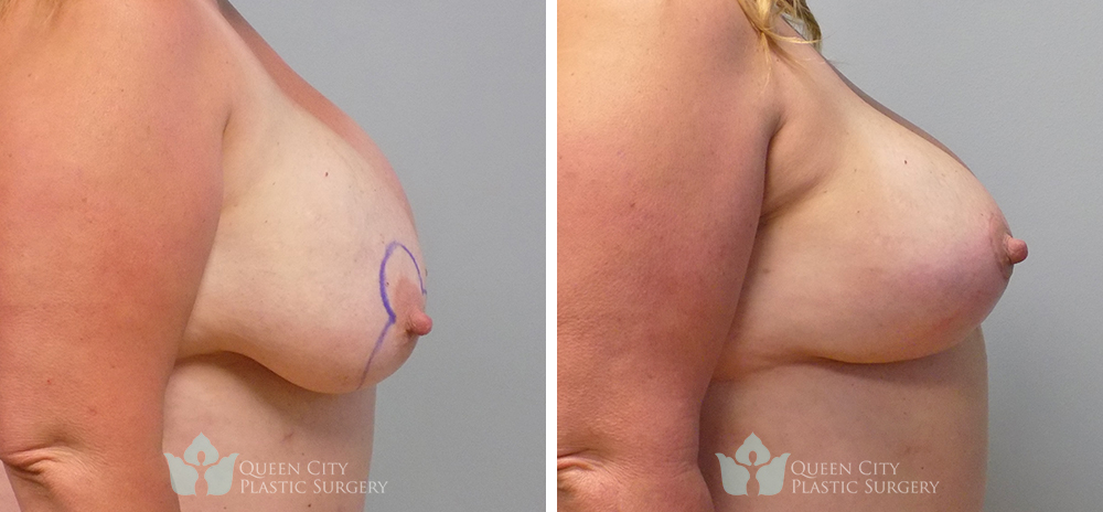 Real Patient of Dr. Enam Haque of Queen City Plastic Surgery in Charlotte, NC