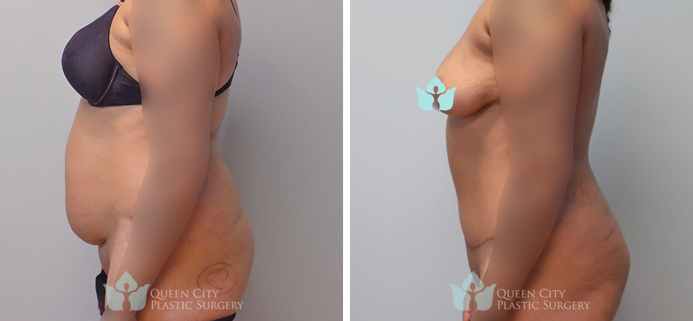 Real Patient of Dr. Enam Haque of Queen City Plastic Surgery in Charlotte, NC