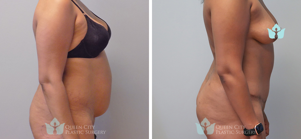 Real Patient of Dr. Enam Haque of Queen City Plastic Surgery in Charlotte, NC