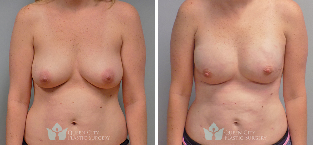 Real Patient of Dr. Enam Haque of Queen City Plastic Surgery in Charlotte, NC