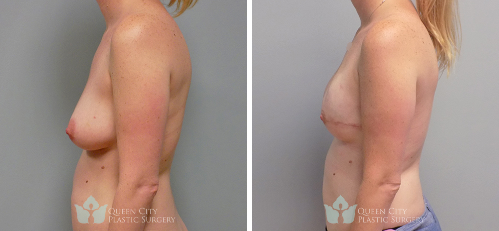 Real Patient of Dr. Enam Haque of Queen City Plastic Surgery in Charlotte, NC