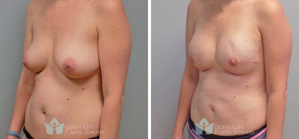 Real Patient of Dr. Enam Haque of Queen City Plastic Surgery in Charlotte, NC