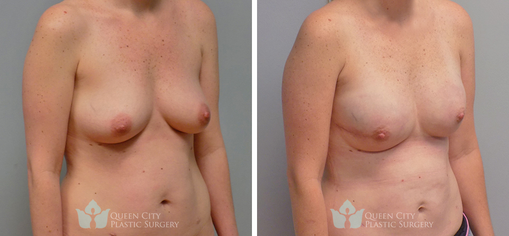 Real Patient of Dr. Enam Haque of Queen City Plastic Surgery in Charlotte, NC