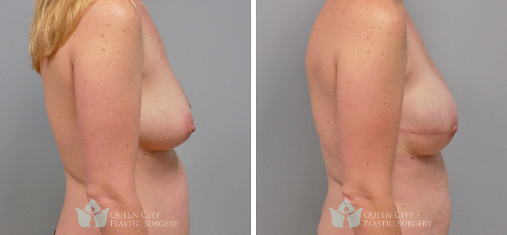 Real Patient of Dr. Enam Haque of Queen City Plastic Surgery in Charlotte, NC