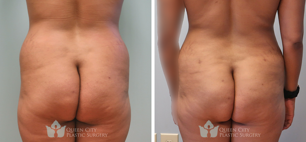 Real Patient of Dr. Enam Haque of Queen City Plastic Surgery in Charlotte, NC