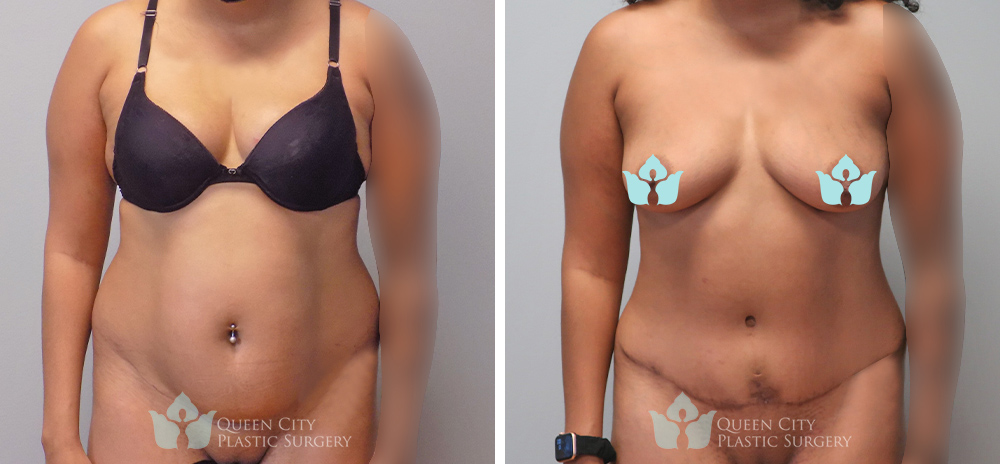 Real Patient of Dr. Enam Haque of Queen City Plastic Surgery in Charlotte, NC